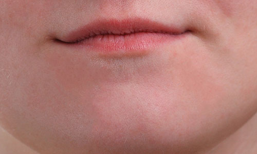 The girl's chin is now pimple free. Image © 2013 Photoshop Essentials.com