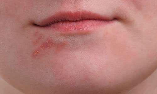 The cluster of pimples on the right has been cleaned up. Image © 2013 Photoshop Essentials.com