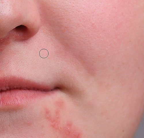 Removing more pimples with the Spot Healing Brush. Image © 2013 Photoshop Essentials.com