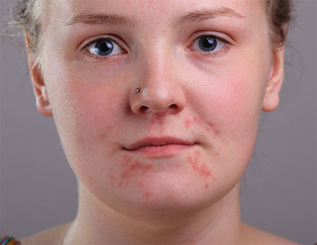 Image of acne on face. Image  82534531 licensed from Shutterstock by Photoshop Essentials.com