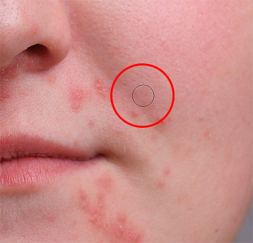 The pimple has been removed with the Spot Healing Brush in Photoshop. Image © 2013 Photoshop Essentials.com