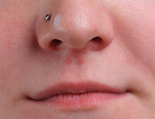 The remaining area of pimples under the girl's nose. Image © 2013 Photoshop Essentials.com