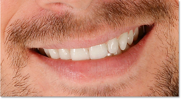 The result after removing too much yellow from the teeth.