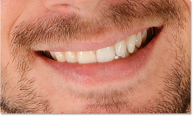 A before and after comparison of the teeth whitening so far.