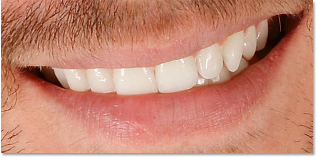 The teeth after cleaning up the surrounding areas.