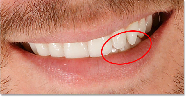 The teeth after cleaning up the surrounding areas.