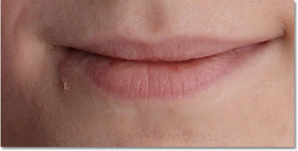 A larger area of pimples below the corner of the girl's mouth. Image © 2010 Photoshop Essentials.com