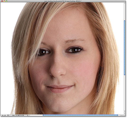 The acne has been removed with the Spot Healing Brush in Photoshop. Image © 2010 Photoshop Essentials.com