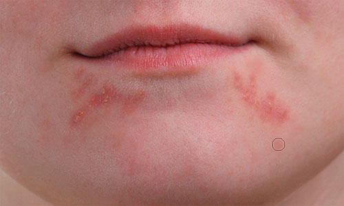 Removing the isolated pimples from the girl's chin with the Spot Healing Brush.