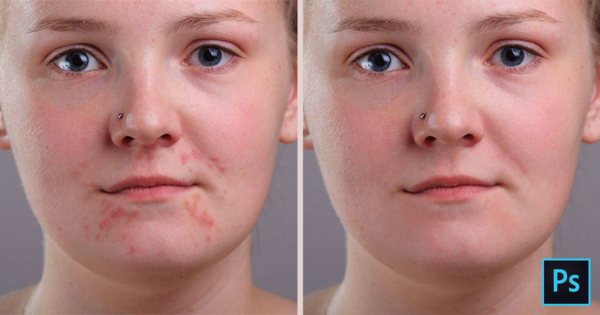 remove-acne-and-skin-blemishes-in-photoshop-photoshop-essentials