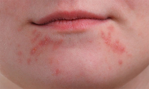 A close-up of the girl's chin showing larger clusters of pimples. 